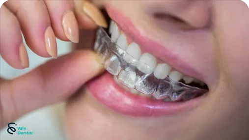 Cong nghe Cong nghe Smart Stage Invisalign V1