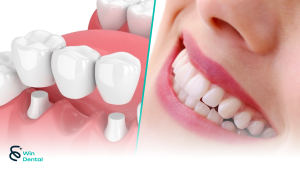 Bọc chụp răng sứ tại Win Dental