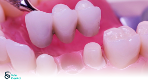 Cầu răng sứ – Giải pháp phục hình răng mất hiệu quả