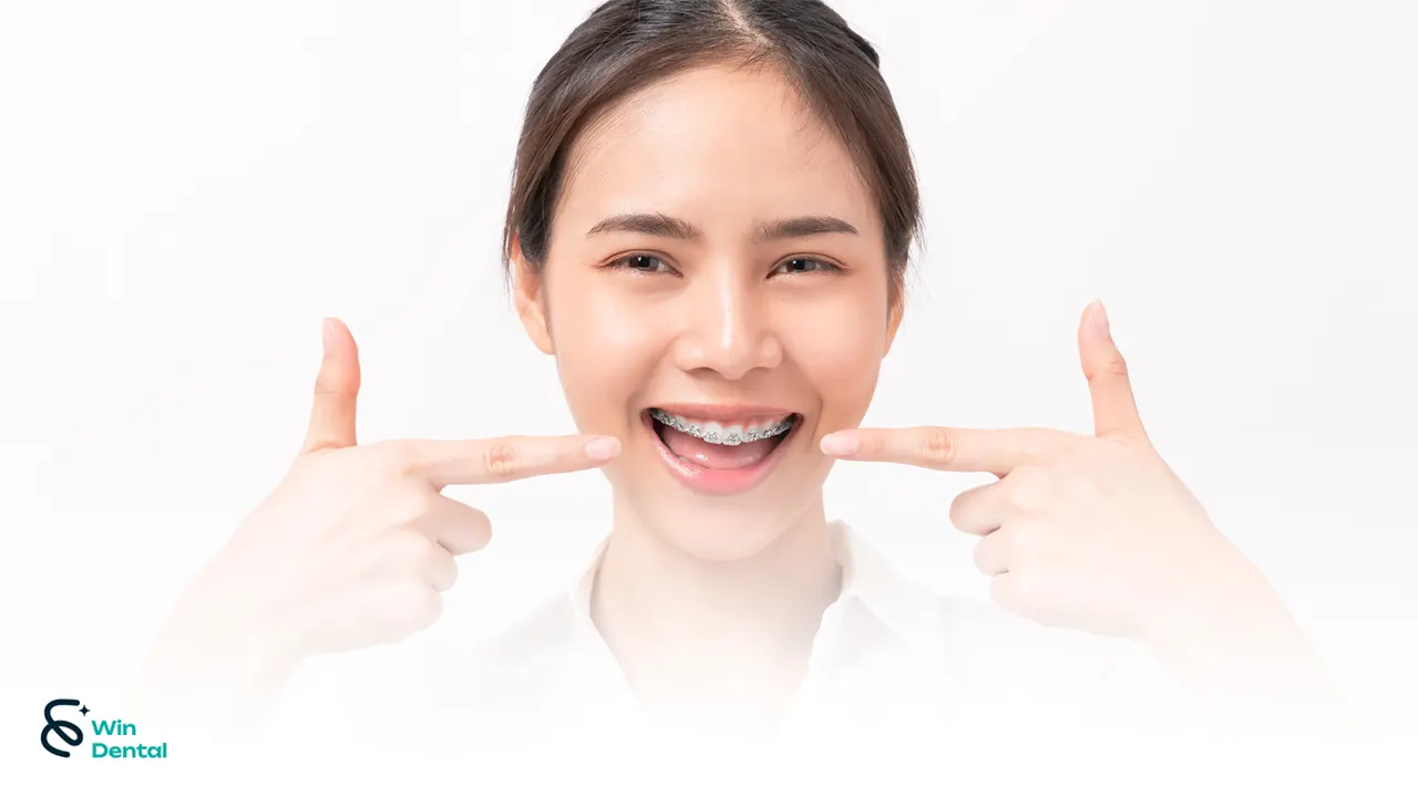 Niềng răng mắc cài