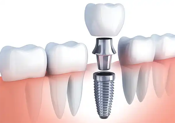 Trong rang Implant 1