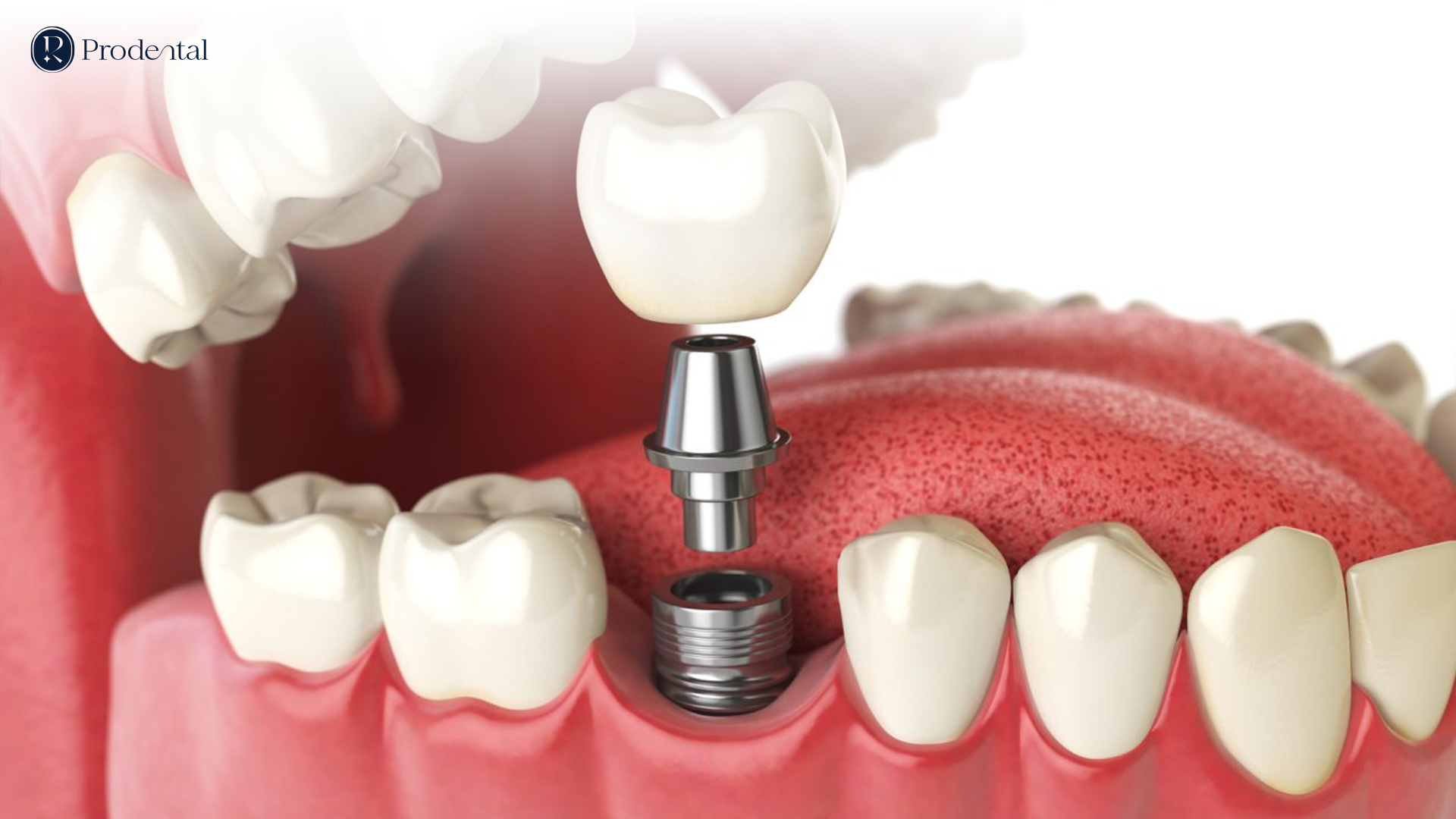 Trồng răng Implant 5 IMPLANT 1