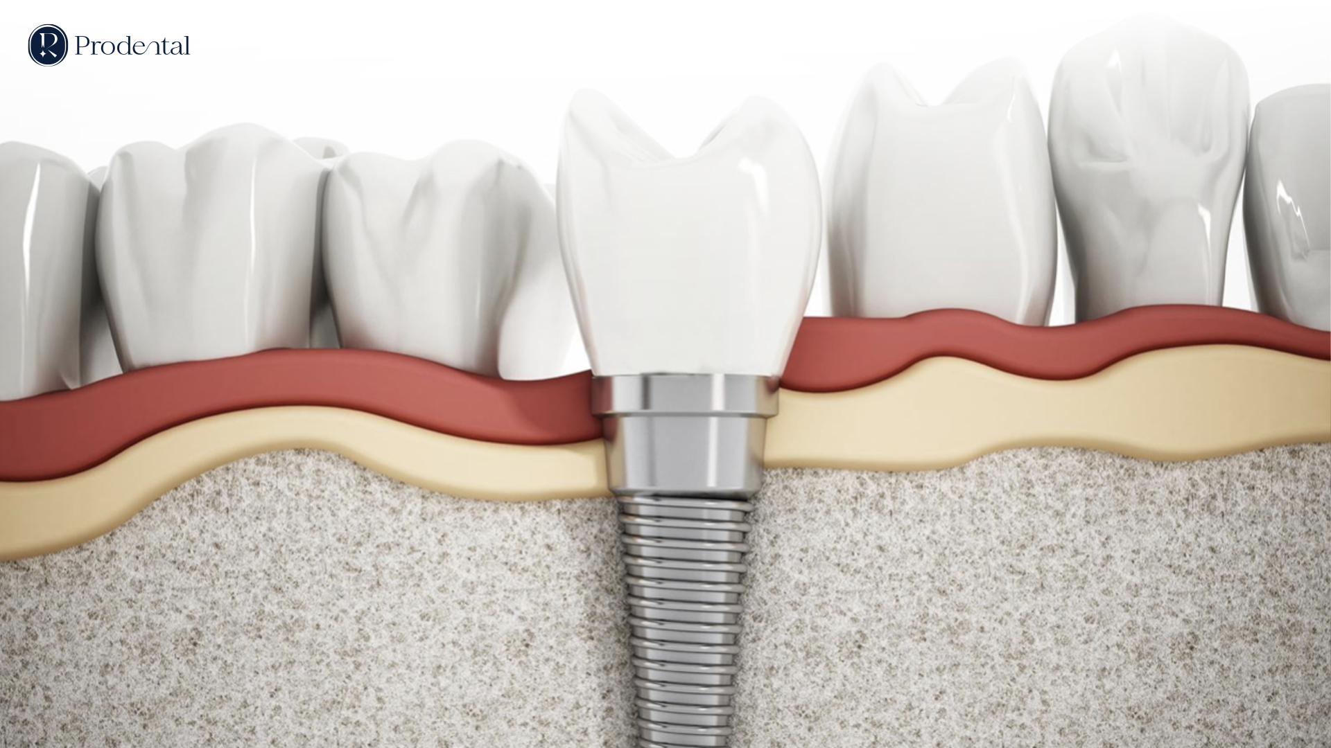 Trồng răng Implant 6 IMPLANT 2