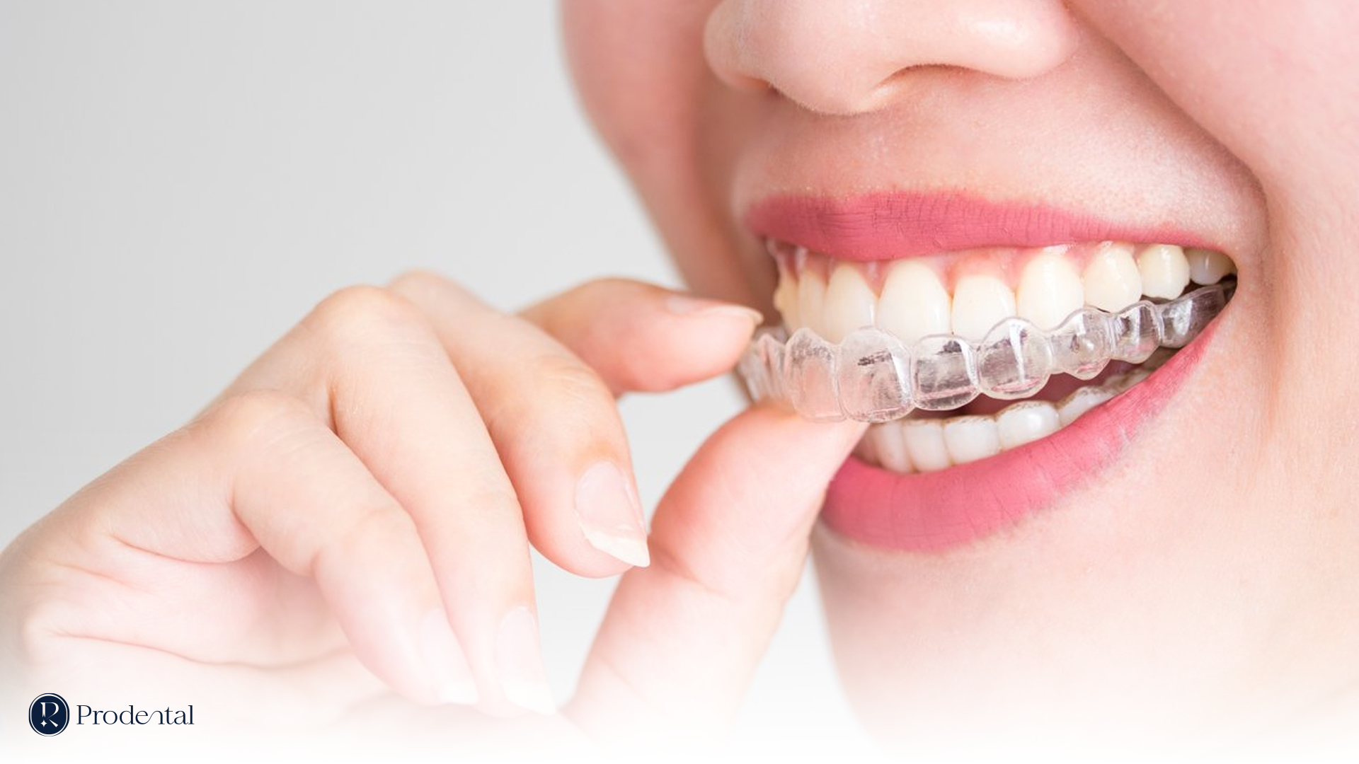 Trang chủ 22 INVISALIGN