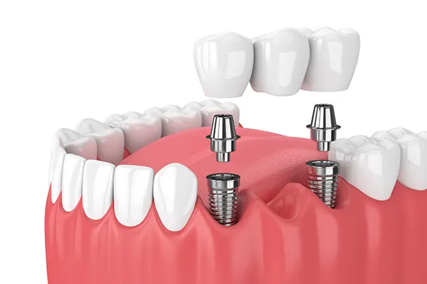 Trang chủ 11 Implant Pro