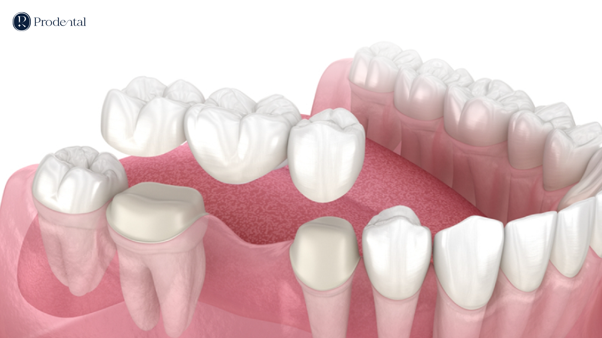 Bọc chụp răng sứ 2 RANG SU 1 1