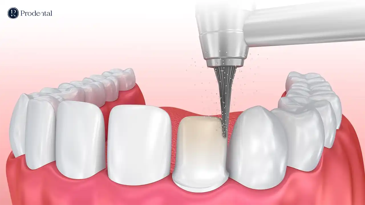 Răng sứ thẩm mỹ 9 Răng sứ thẩm mỹ