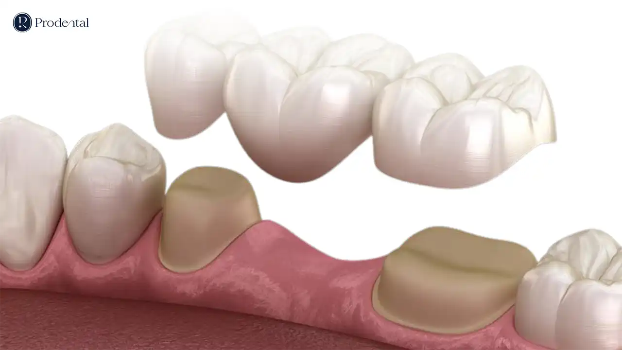 Cầu răng sứ 2 Cầu răng sứ