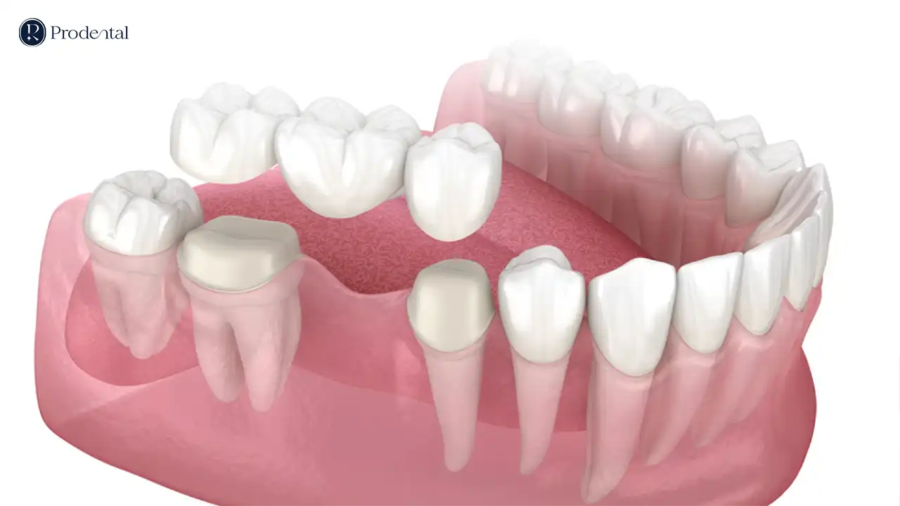 Cầu răng sứ 4 cau rang su Pro 2