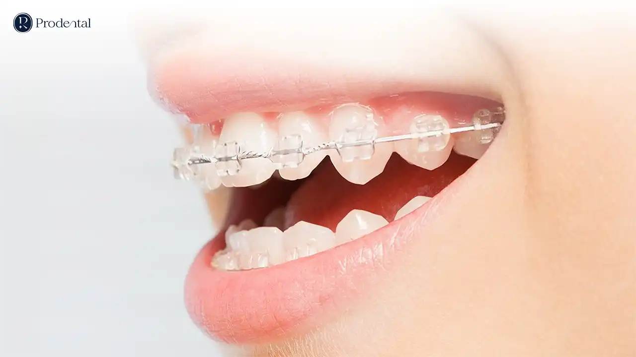 Niềng răng mắc cài 2 Niềng răng mắc cài