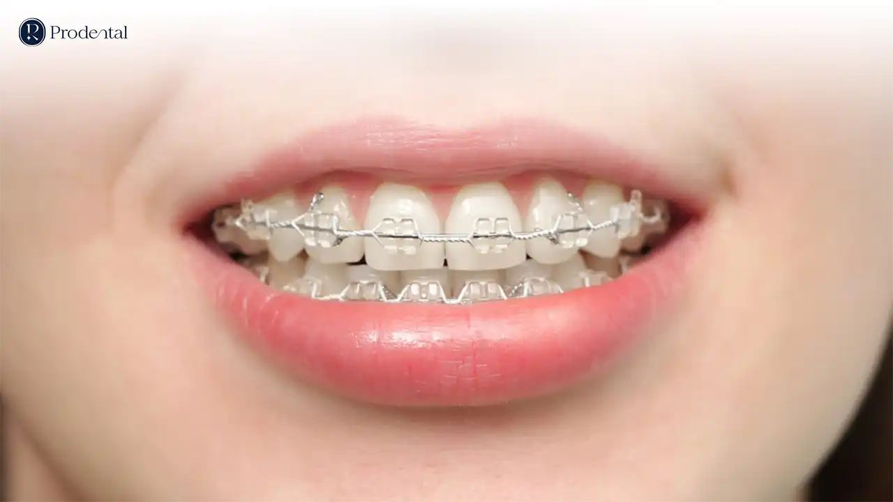 Niềng răng mắc cài 4 Niềng răng mắc cài