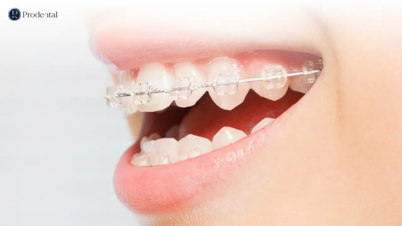 Niềng răng mắc cài 5 nieng rang mac cai Pro 3