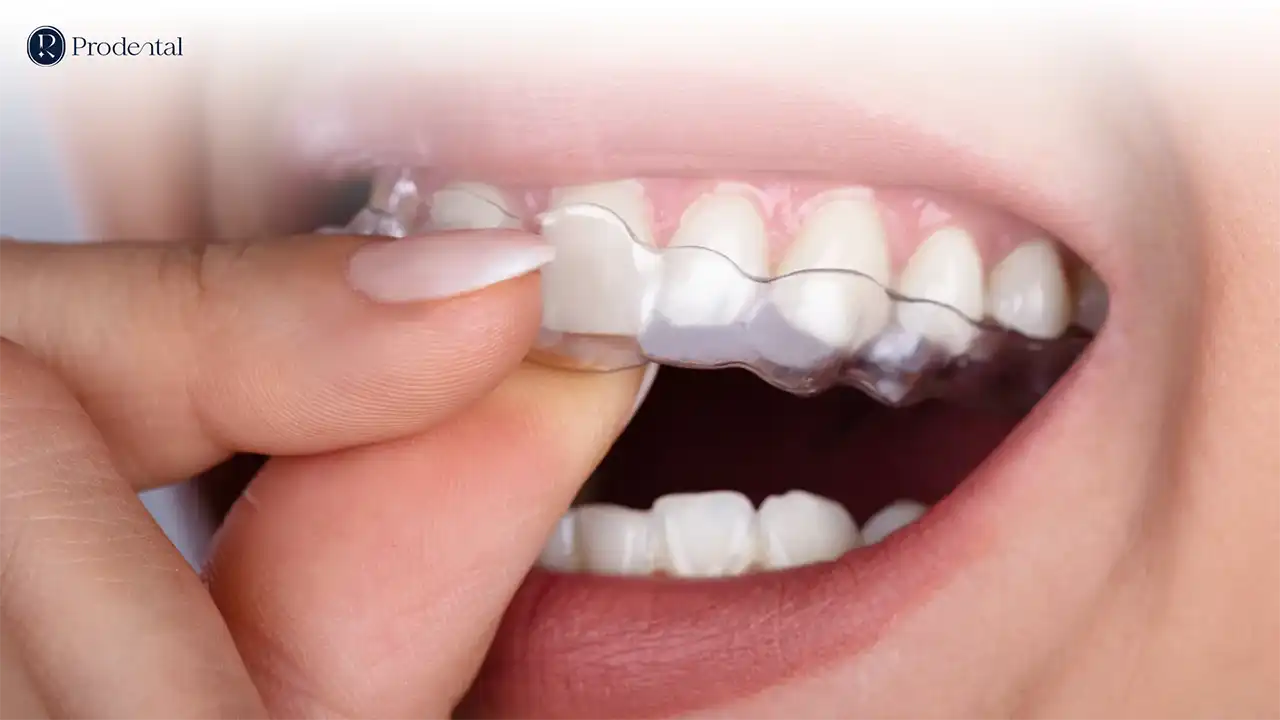 Niềng răng trong suốt 2 Niềng răng trong suốt