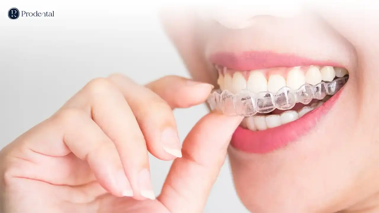 Niềng răng trong suốt 4 Niềng răng trong suốt