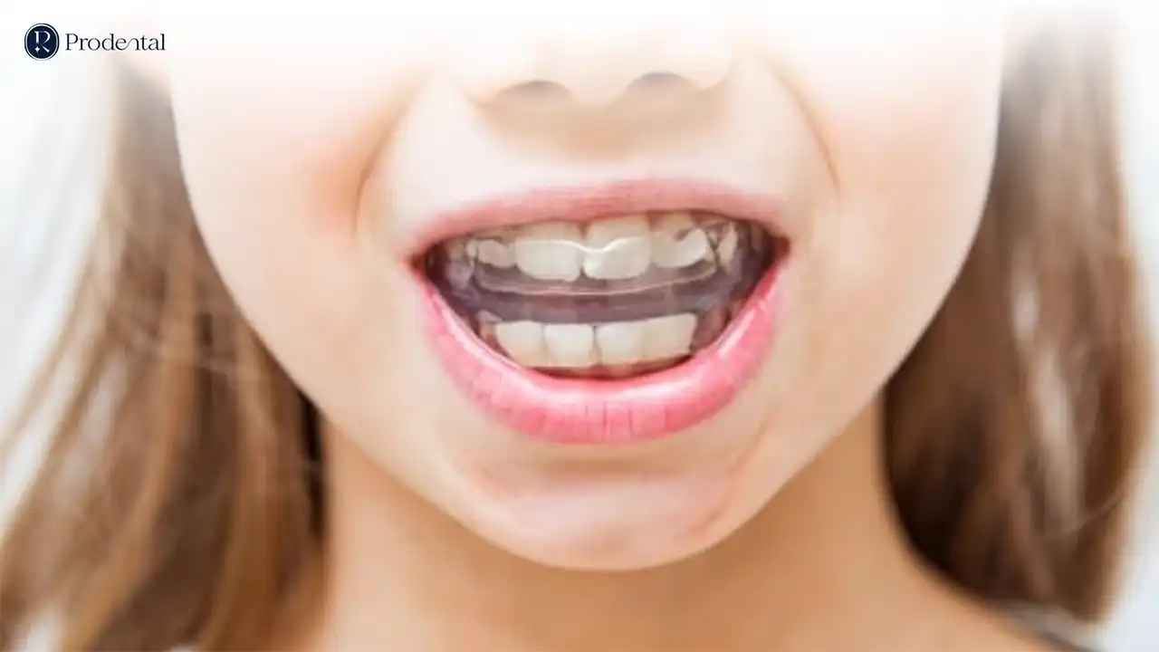 Tiền chỉnh nha 2 Tiền chỉnh nha