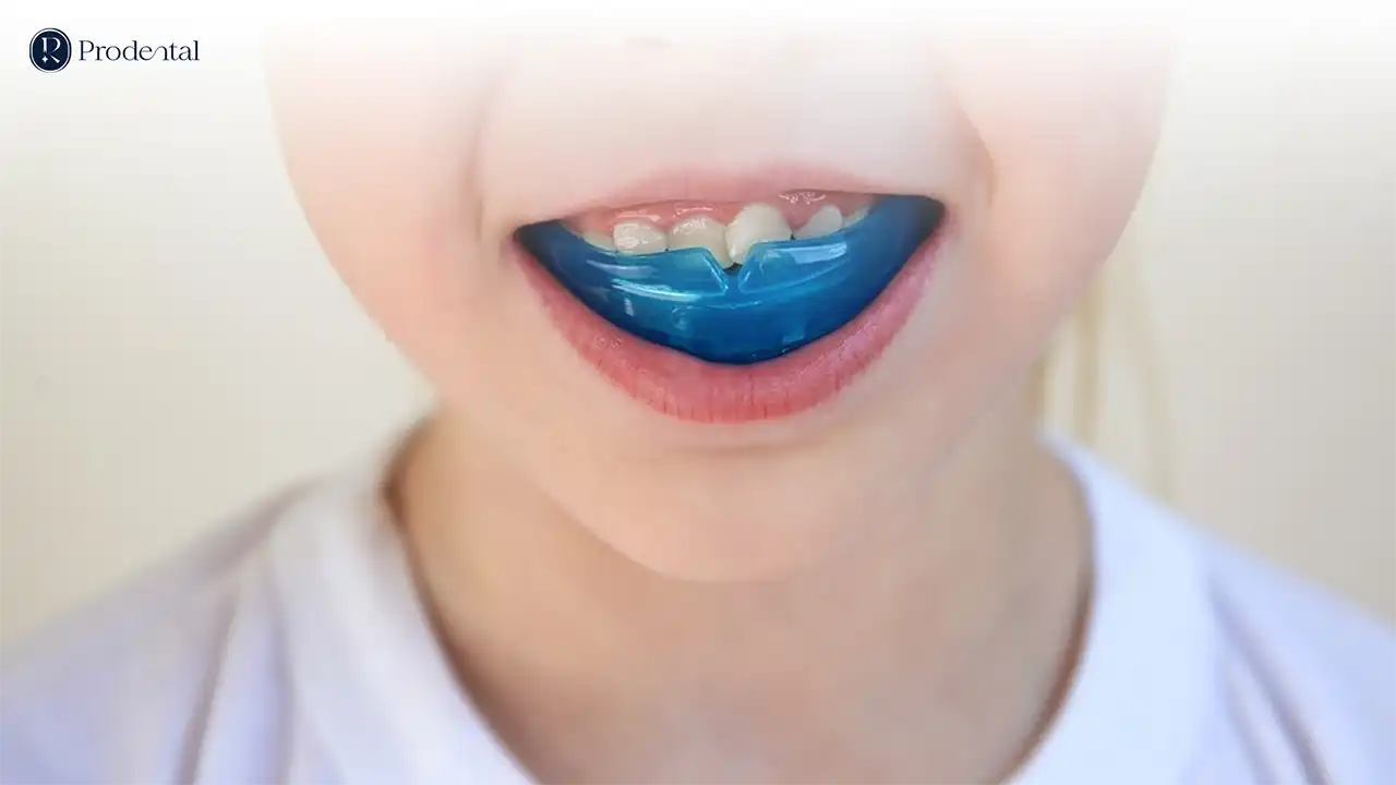 Tiền chỉnh nha 4 Tiền chỉnh nha