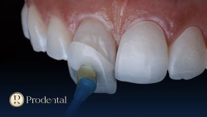 Bọc răng sứ và dán sứ veneer: Khác nhau gì, nên chọn loại nào? 4 Dán sứ veneer