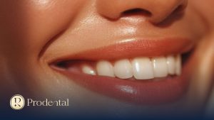 Bọc răng sứ và dán sứ veneer: Khác nhau gì, nên chọn loại nào? 3 Bọc răng sứ